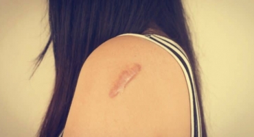 Como evitar cicatriz na pele?